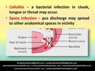 • Cellulitis – a bacterial infection in cheek,
tongue or throat may occur.
• Space infection – pus discharge may spread
to other anatomical spaces in vicinity
 