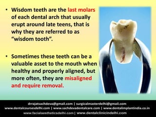 • Wisdom teeth are the last molars
of each dental arch that usually
erupt around late teens, that is
why they are referred to as
“wisdom tooth”.
• Sometimes these teeth can be a
valuable asset to the mouth when
healthy and properly aligned, but
more often, they are misaligned
and require removal.
 