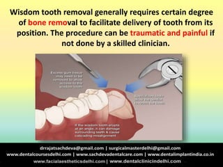 Wisdom tooth removal generally requires certain degree
of bone removal to facilitate delivery of tooth from its
position. The procedure can be traumatic and painful if
not done by a skilled clinician.
 