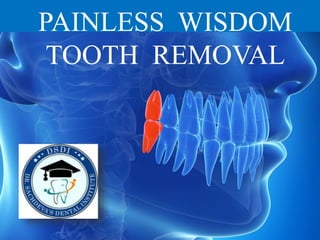 PAINLESS WISDOM
TOOTH REMOVAL
 