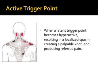 • When a latent trigger point
becomes hyperactive,
resulting in a localized spasm,
creating a palpable knot, and
producing referred pain.
 