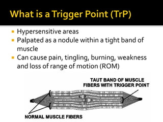 Hypersensitive areas
 Palpated as a nodule within a tight band of
muscle
 Can cause pain, tingling, burning, weakness
and loss of range of motion (ROM)
 