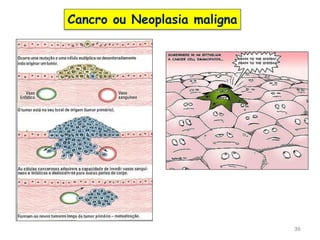 36
Cancro ou Neoplasia maligna
 