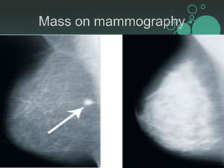 Mammogram Slides Mammography.pptx