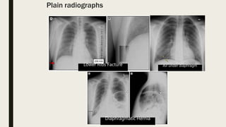Plain radiographs
Air under diaphragm
Lower Ribs Facture
Diaphragmatic Hernia
 