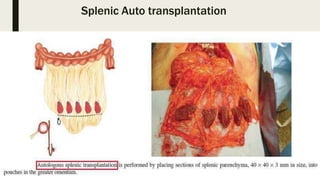 Splenic Auto transplantation
 