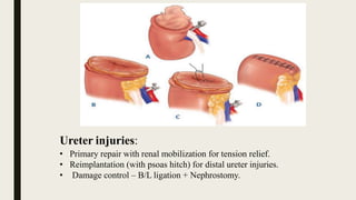 Ureter injuries:
• Primary repair with renal mobilization for tension relief.
• Reimplantation (with psoas hitch) for distal ureter injuries.
• Damage control – B/L ligation + Nephrostomy.
 
