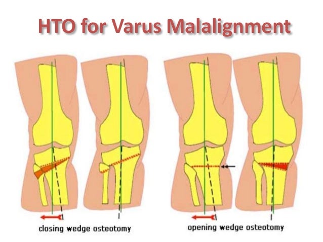 joint paracetamol Osteoarthritis