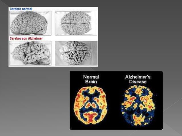 Ppt Alzheimer Ppt