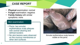 annular secondary syphilis a case report | PPTX