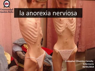 la anorexia nerviosa
Cristopher Cifuentes Carreño
Enfermería
30/05/2014
 