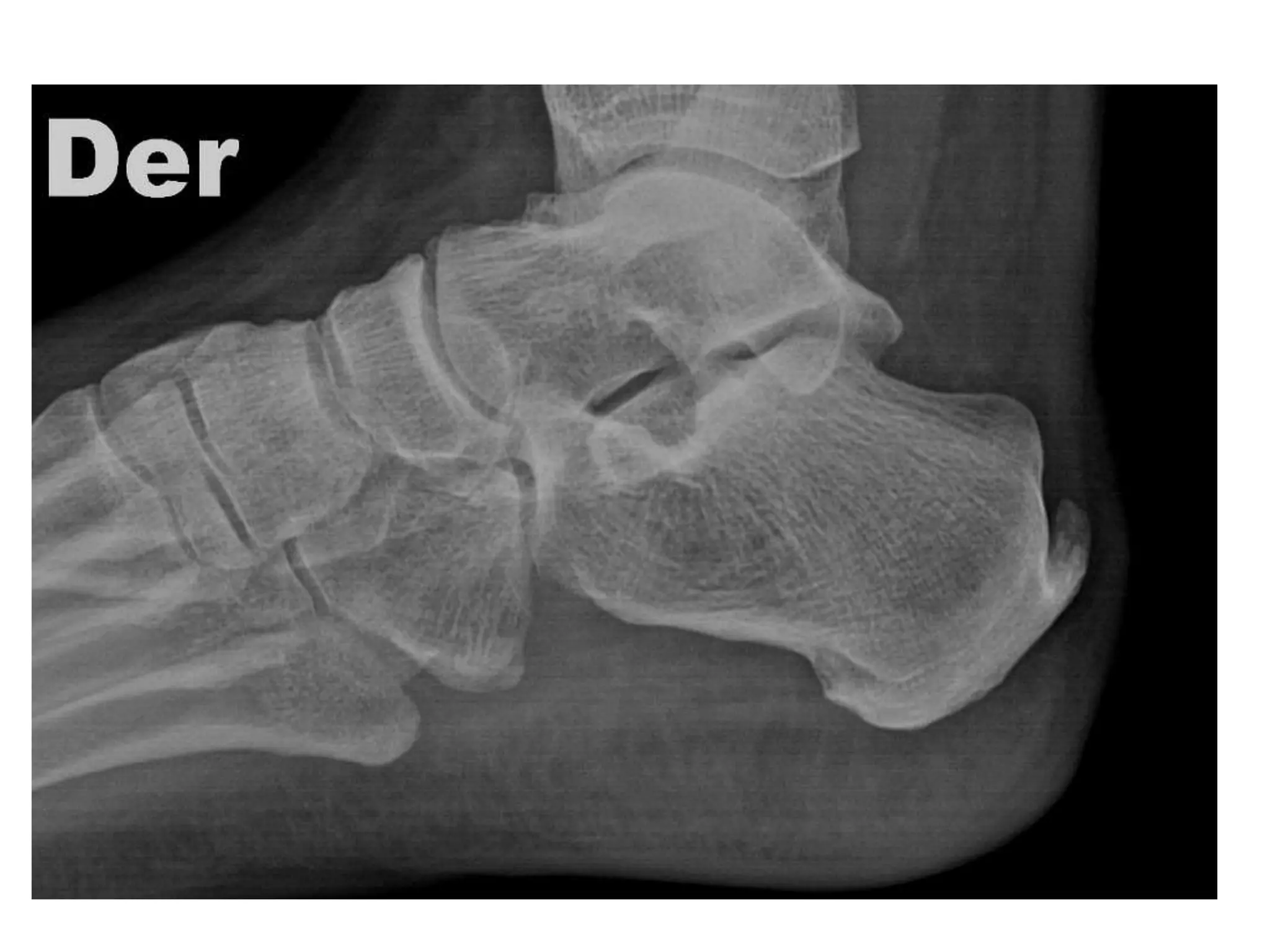 Ppt Approach to Rickets and it's Management | PPTX