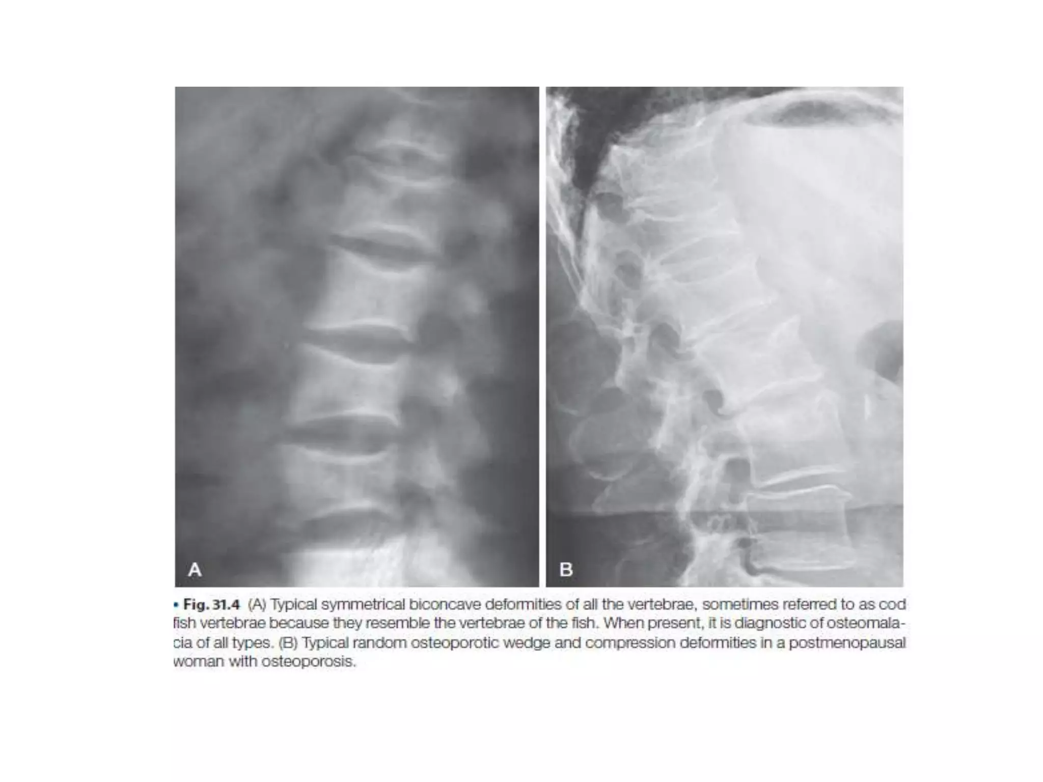 Approach to Rickets and relevant metabolic bone disorders | PPTX