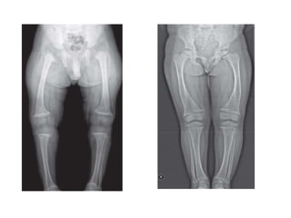 Approach to Rickets and relevant metabolic bone disorders | PPTX