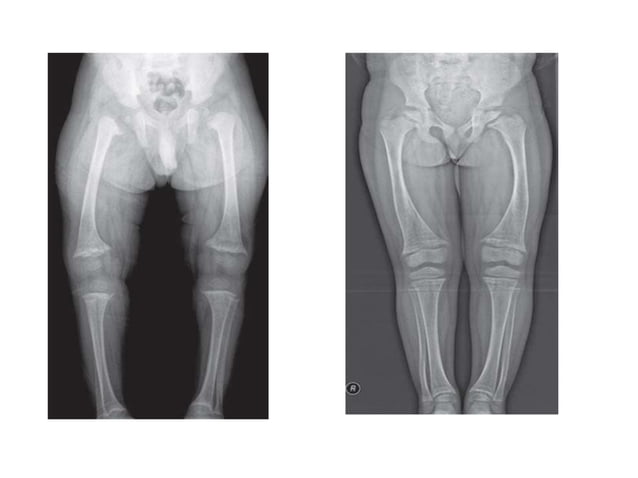 Land Rickets Approach to Rickets and relevant metabolic bone disorders | PPT