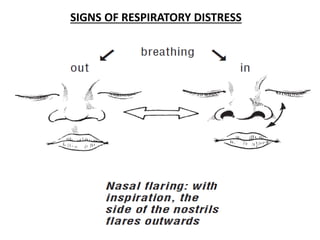 SIGNS OF RESPIRATORY DISTRESS
 