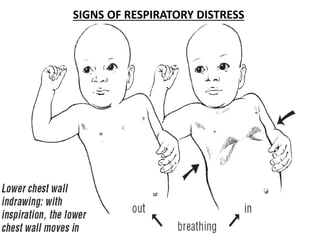 SIGNS OF RESPIRATORY DISTRESS
 