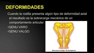 DEFORMIDADES
Cuando la rodilla presenta algún tipo de deformidad axial
el resultado es la sobrecarga mecánica de un
comportamiento articular.
•GENU VARO
•GENU VALGO
 