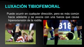 LUXACIÓN TIBIOFEMORAL
Puede ocurrir en cualquier dirección, pero es más común
hacia adelante y se asocia con una fuerza que causa
hiperextensión de la rodilla.
 