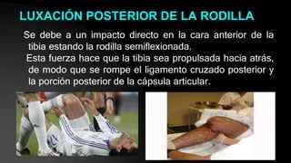 LUXACIÓN POSTERIOR DE LA RODILLA
Se debe a un impacto directo en la cara anterior de la
tibia estando la rodilla semiflexionada.
Esta fuerza hace que la tibia sea propulsada hacia atrás,
de modo que se rompe el ligamento cruzado posterior y
la porción posterior de la cápsula articular.
 