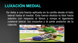 LUXACIÓN MEDIAL
Se debe a una fuerza aplicada en la canilla desde el lado
lateral hasta el medial. Esta fuerza desliza la tibia hacia
adentro con respecto al fémur y rompe el ligamento
colateral lateral, los cruzados y la parte posterior de la
cápsula.
 
