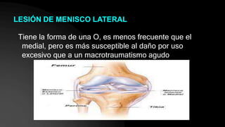 LESIÓN DE MENISCO LATERAL
Tiene la forma de una O, es menos frecuente que el
medial, pero es más susceptible al daño por uso
excesivo que a un macrotraumatismo agudo
 