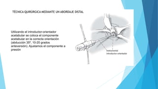 PPT ARTROPLASTIA DE CADERA GRUPO 1 FINAL (3).pptx
