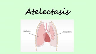 Atelectasis
 