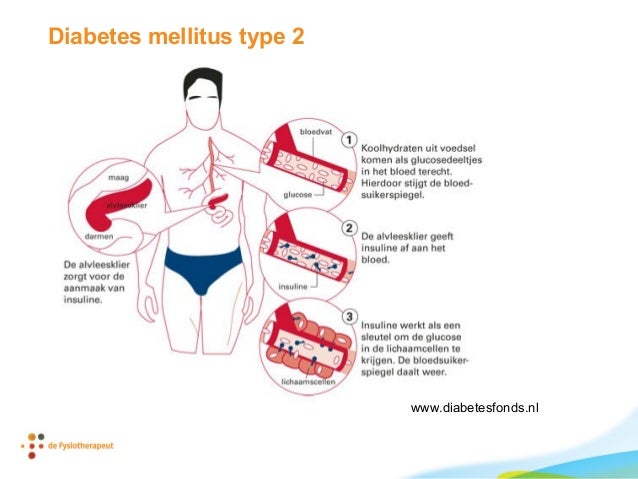 risicofactoren diabetes type 2