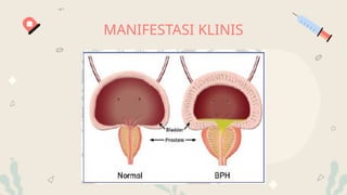 MANIFESTASI KLINIS
 