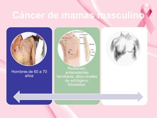 Cáncer de mamas masculino
 