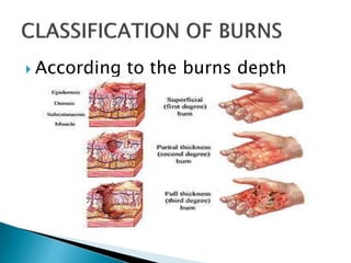  According to the burns depth
 