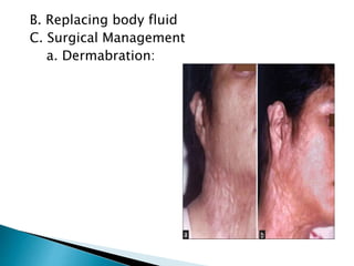 B. Replacing body fluid
C. Surgical Management
a. Dermabration:
 
