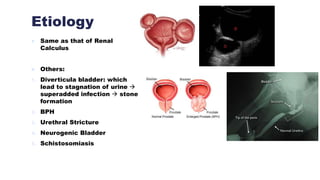 Etiology
 Same as that of Renal
Calculus
 Others:
1. Diverticula bladder: which
lead to stagnation of urine 
superadded infection  stone
formation
2. BPH
3. Urethral Stricture
4. Neurogenic Bladder
5. Schistosomiasis
 