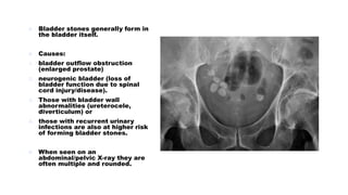  Bladder stones generally form in
the bladder itself.
 Causes:
1. bladder outflow obstruction
(enlarged prostate)
2. neurogenic bladder (loss of
bladder function due to spinal
cord injury/disease).
3. Those with bladder wall
abnormalities (ureterocele,
diverticulum) or
4. those with recurrent urinary
infections are also at higher risk
of forming bladder stones.
 When seen on an
abdominal/pelvic X-ray they are
often multiple and rounded.
 