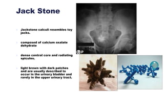 Jack Stone
 Jackstone calculi resembles toy
jacks.
 composed of calcium oxalate
dehydrate
 dense central core and radiating
spicules.
 light brown with dark patches
and are usually described to
occur in the urinary bladder and
rarely in the upper urinary tract.
 