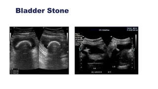 Bladder Stone
 