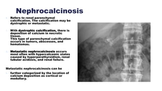 Nephrocalcinosis
 Refers to renal parenchymal
calcification. The calcification may be
dystrophic or metastatic.
1. With dystrophic calcification, there is
deposition of calcium in necrotic
tissue.
This type of parenchymal calcification
occurs in tumors, abscesses, and
hematomas.
2. Metastatic nephrocalcinosis occurs
most often with hypercalcemic states
caused by hyperparathyroidism, renal
tubular acidosis, and renal failure.
Metastatic nephrocalcinosis can be
 further categorized by the location of
calcium deposition as cortical or
medullary.
 