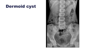 Dermoid cyst
 