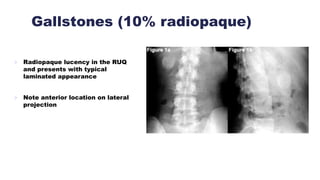 Gallstones (10% radiopaque)
 Radiopaque lucency in the RUQ
and presents with typical
laminated appearance
 Note anterior location on lateral
projection
 
