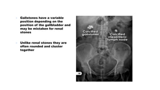  Gallstones have a variable
position depending on the
position of the gallbladder and
may be mistaken for renal
stones
 Unlike renal stones they are
often rounded and cluster
together
 
