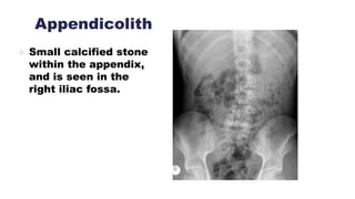 Appendicolith
 Small calcified stone
within the appendix,
and is seen in the
right iliac fossa.
 