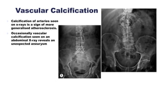 Vascular Calcification
 Calcification of arteries seen
on x-rays is a sign of more
generalised atherosclerosis.
 Occasionally vascular
calcification seen on an
abdominal X-ray reveals an
unexpected aneurysm
 