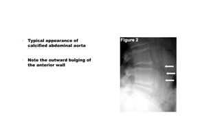  Typical appearance of
calcified abdominal aorta
 Note the outward bulging of
the anterior wall
 