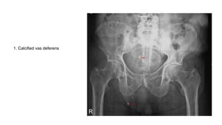 1. Calcified vas deferens
 