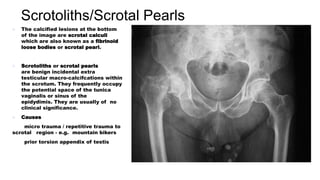  The calcified lesions at the bottom
of the image are scrotal calculi
which are also known as a fibrinoid
loose bodies or scrotal pearl.
 Scrotoliths or scrotal pearls
are benign incidental extra
testicular macro-calcifcations within
the scrotum. They frequently occupy
the potential space of the tunica
vaginalis or sinus of the
epidydimis. They are usually of no
clinical significance.
 Causes
micro trauma / repetitive trauma to
scrotal region - e.g. mountain bikers
prior torsion appendix of testis
Scrotoliths/Scrotal Pearls
 