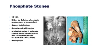Phosphate Stones
 10-15%
 Either be Calcium phosphate
(magnesium or ammonium)
 Occurs in infection
 Smooth and white color
 In alkaline urine, it enlarges
rapidly, filling renal calyces
and taking their shape
(STAGHORN CALCULUS).
 Radiopaque
 