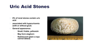 Uric Acid Stones
 8% of renal stones contain uric
acid
 associated with hyperuricemia
(with or without gout)
 General appearance:
1. Small, friable, yellowish
2. May form staghorn
3. Radiolucent (plain x-rays
cannot detect)
 