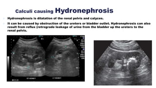 Calculi causing Hydronephrosis
 Hydronephrosis is dilatation of the renal pelvis and calyces.
 It can be caused by obstruction of the ureters or bladder outlet. Hydronephrosis can also
result from reflux (retrograde leakage of urine from the bladder up the ureters to the
renal pelvis.
 