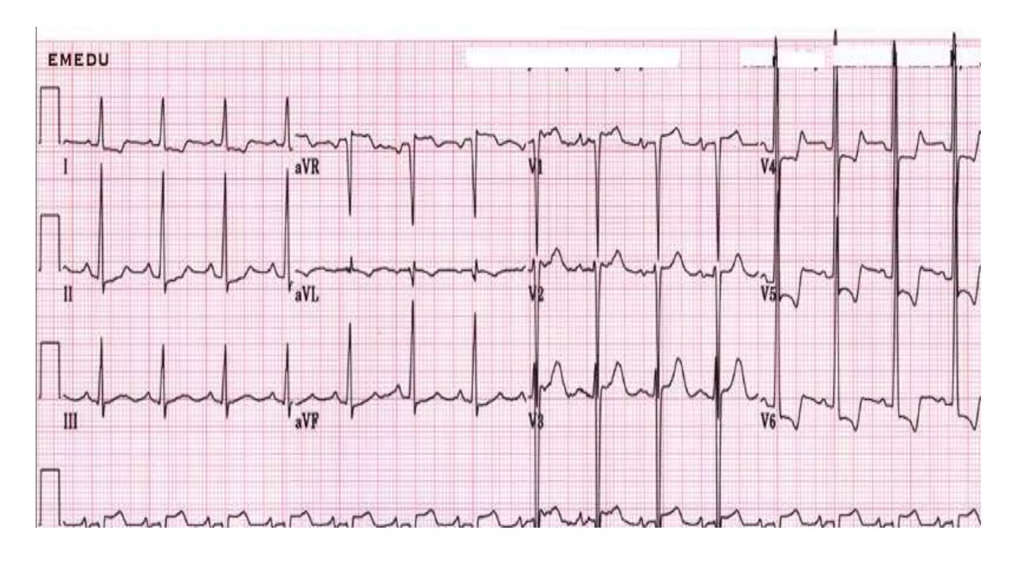 PPT CARDIO - EKG.pptx